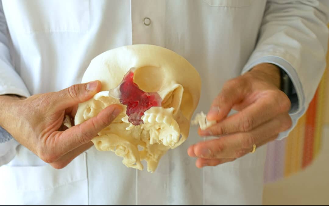 Entfernung eines Augentumors Dank 3D-Druck